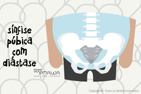 Pilates na gestação - diástase da sínfise púbica